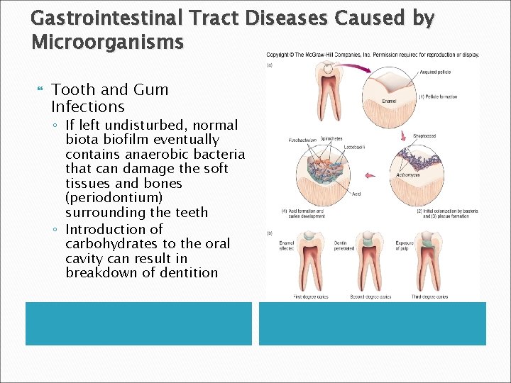 Gastrointestinal Tract Diseases Caused by Microorganisms Tooth and Gum Infections ◦ If left undisturbed,