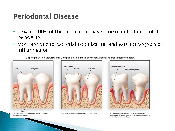 Periodontal Disease 97% to 100% of the population has some manifestation of it by