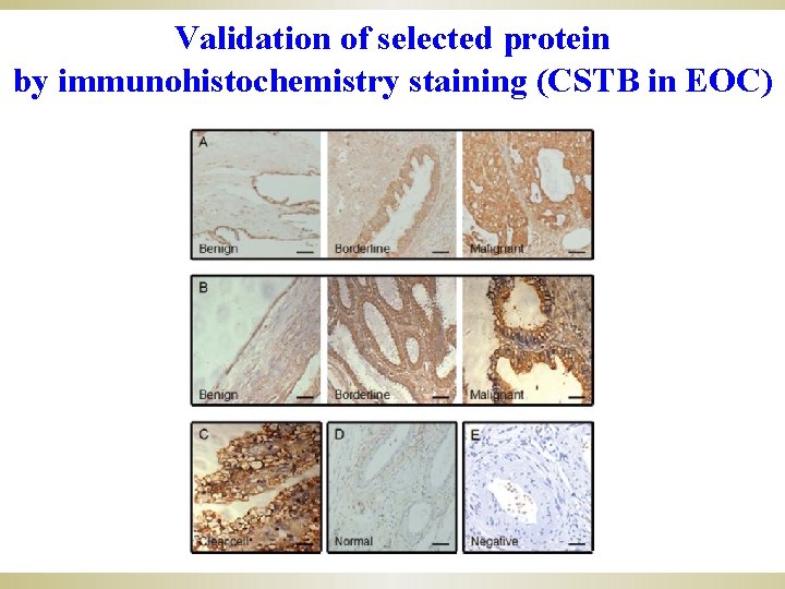 Validation of selected protein by immunohistochemistry staining (CSTB in EOC) 