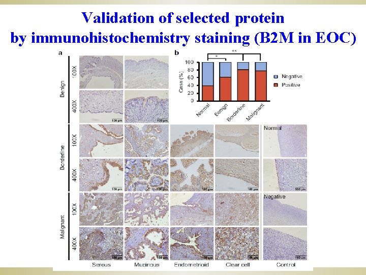 Validation of selected protein by immunohistochemistry staining (B 2 M in EOC) 