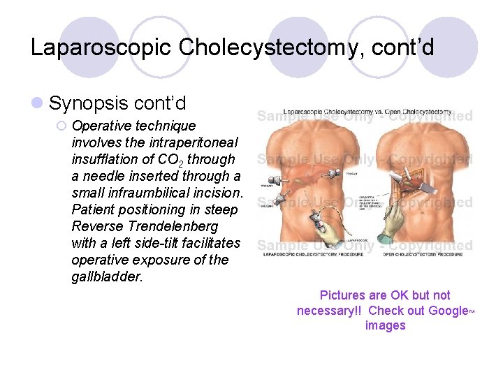 Laparoscopic Cholecystectomy, cont’d l Synopsis cont’d ¡ Operative technique involves the intraperitoneal insufflation of Laparoscopic Cholecystectomy, cont’d l Synopsis cont’d ¡ Operative technique involves the intraperitoneal insufflation of
