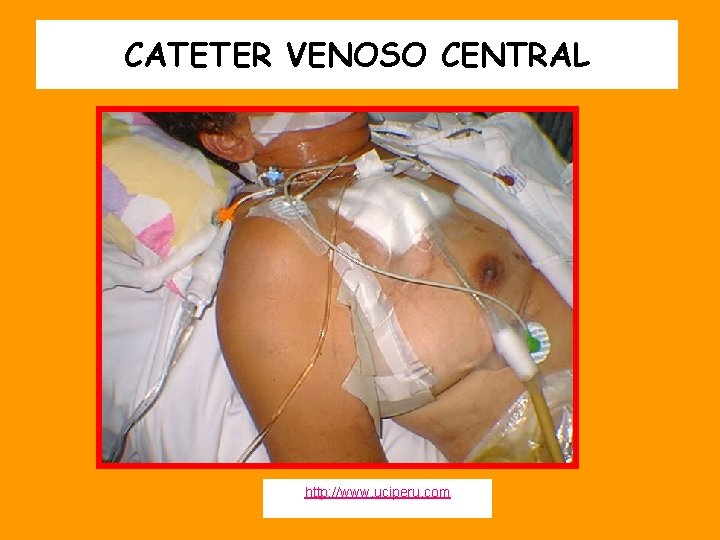 CATETER VENOSO CENTRAL http: //www. uciperu. com 