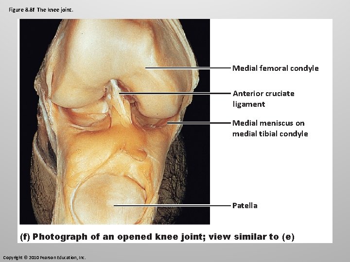 Figure 8. 8 f The knee joint. Medial femoral condyle Anterior cruciate ligament Medial