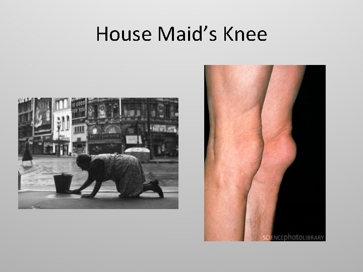 House Maid’s Knee 