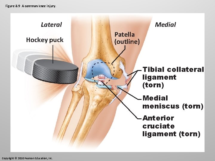 Figure 8. 9 A common knee injury. Lateral Hockey puck Medial Patella (outline) Tibial