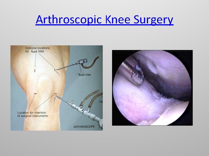 Arthroscopic Knee Surgery 