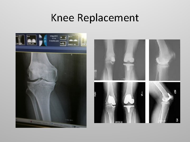 Knee Replacement 