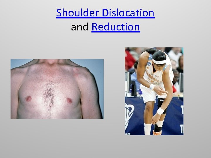 Shoulder Dislocation and Reduction 