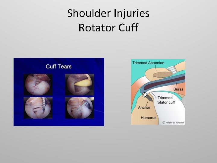 Shoulder Injuries Rotator Cuff 