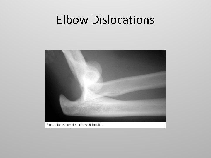 Elbow Dislocations 