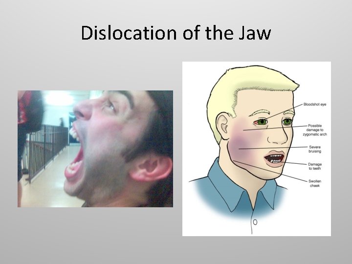 Dislocation of the Jaw 