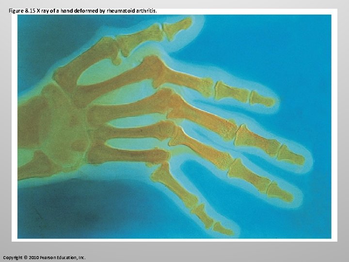 Figure 8. 15 X ray of a hand deformed by rheumatoid arthritis. Copyright ©