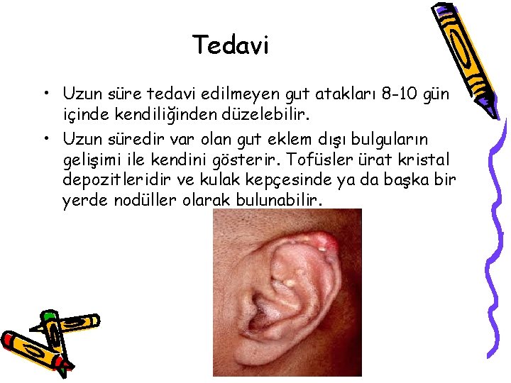 Tedavi • Uzun süre tedavi edilmeyen gut atakları 8 -10 gün içinde kendiliğinden düzelebilir. Tedavi • Uzun süre tedavi edilmeyen gut atakları 8 -10 gün içinde kendiliğinden düzelebilir.