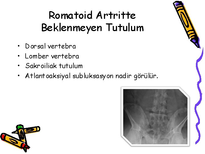 Romatoid Artritte Beklenmeyen Tutulum • • Dorsal vertebra Lomber vertebra Sakroiliak tutulum Atlantoaksiyal subluksasyon Romatoid Artritte Beklenmeyen Tutulum • • Dorsal vertebra Lomber vertebra Sakroiliak tutulum Atlantoaksiyal subluksasyon