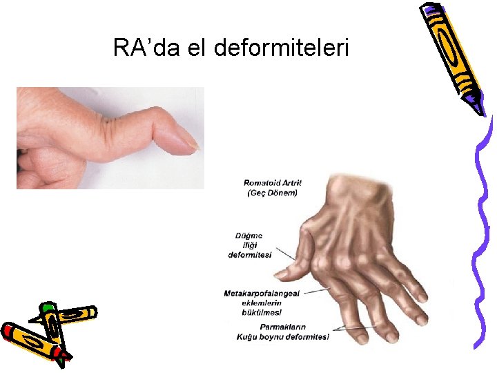 RA’da el deformiteleri RA’da el deformiteleri
