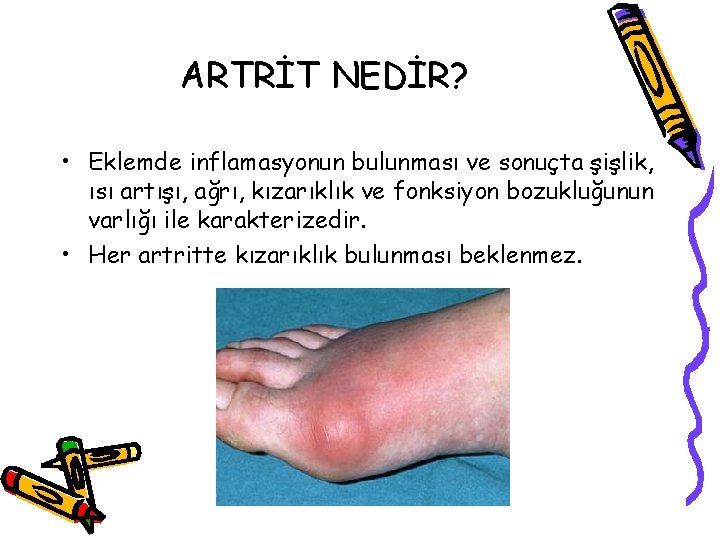 ARTRİT NEDİR? • Eklemde inflamasyonun bulunması ve sonuçta şişlik, ısı artışı, ağrı, kızarıklık ve ARTRİT NEDİR? • Eklemde inflamasyonun bulunması ve sonuçta şişlik, ısı artışı, ağrı, kızarıklık ve