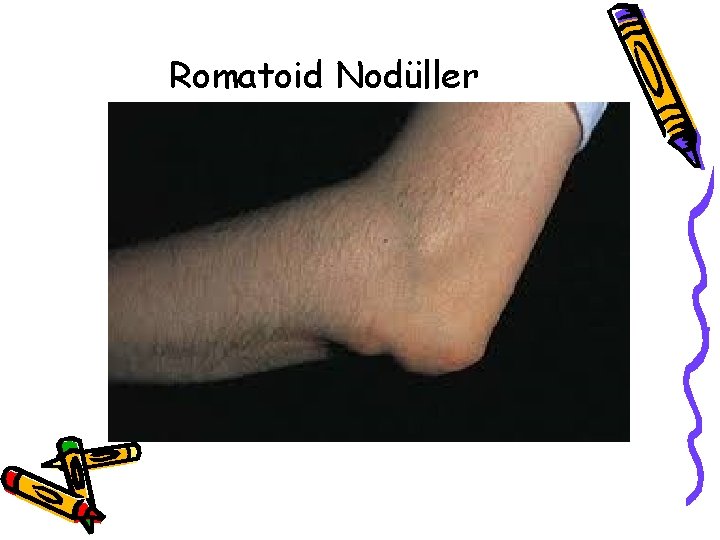 Romatoid Nodüller Romatoid Nodüller