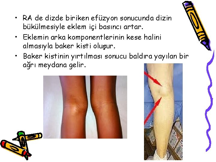 • RA de dizde biriken efüzyon sonucunda dizin bükülmesiyle eklem içi basıncı artar. • RA de dizde biriken efüzyon sonucunda dizin bükülmesiyle eklem içi basıncı artar.