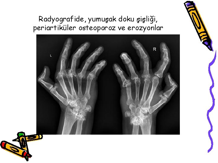 Radyografide, yumuşak doku şişliği, periartiküler osteoporoz ve erozyonlar Radyografide, yumuşak doku şişliği, periartiküler osteoporoz ve erozyonlar