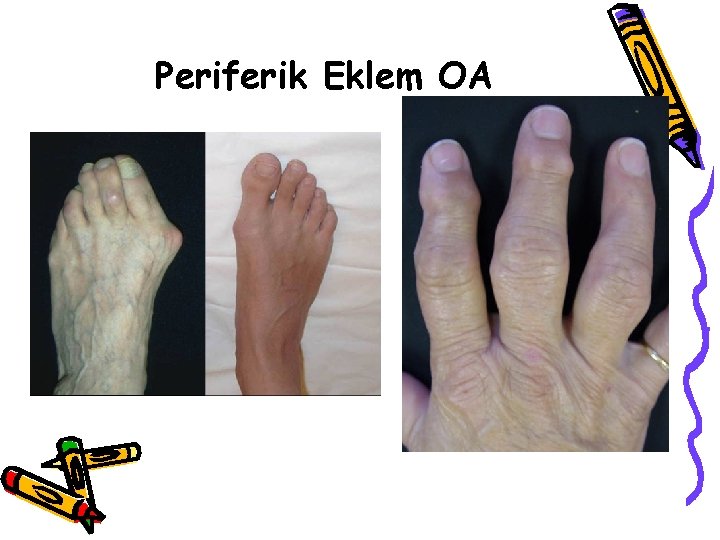 Periferik Eklem OA Periferik Eklem OA