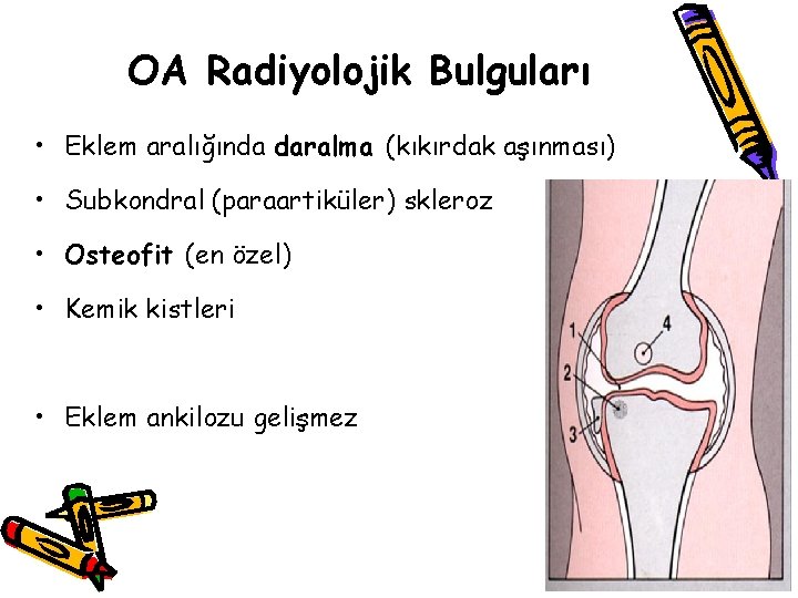 OA Radiyolojik Bulguları • Eklem aralığında daralma (kıkırdak aşınması) • Subkondral (paraartiküler) skleroz • OA Radiyolojik Bulguları • Eklem aralığında daralma (kıkırdak aşınması) • Subkondral (paraartiküler) skleroz •