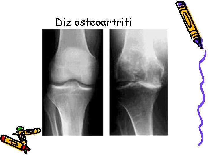 Diz osteoartriti Diz osteoartriti