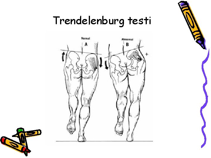 Trendelenburg testi Trendelenburg testi