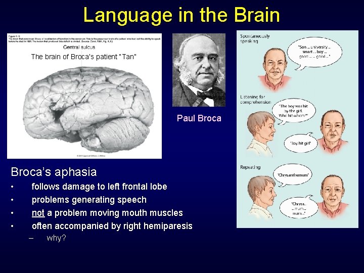 Language in the Brain The brain of Broca’s patient “Tan” Paul Broca’s aphasia • Language in the Brain The brain of Broca’s patient “Tan” Paul Broca’s aphasia •
