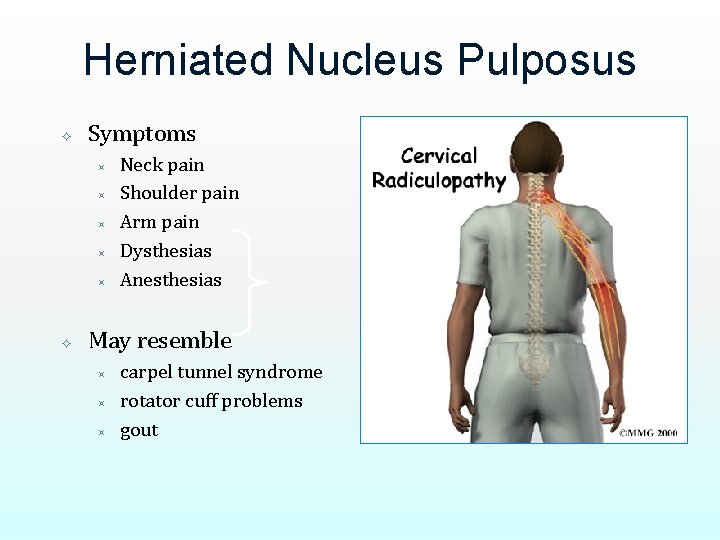 Herniated Nucleus Pulposus Symptoms ³ ³ ³ Neck pain Shoulder pain Arm pain Dysthesias