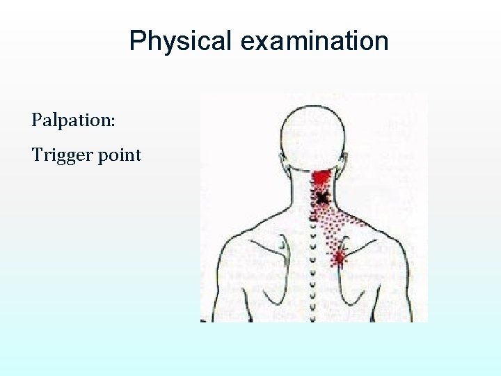 Physical examination Palpation: Trigger point 