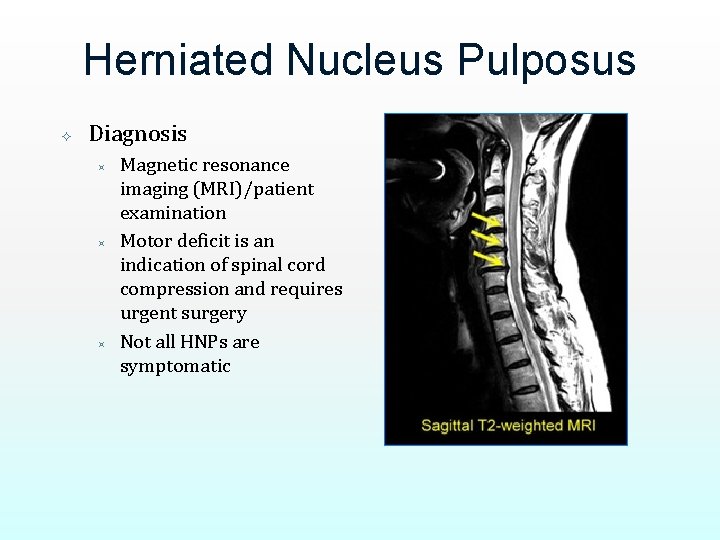 Herniated Nucleus Pulposus Diagnosis ³ ³ ³ Magnetic resonance imaging (MRI)/patient examination Motor deficit