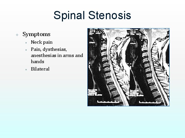 Spinal Stenosis Symptoms ³ ³ ³ Neck pain Pain, dysthesias, anesthesias in arms and