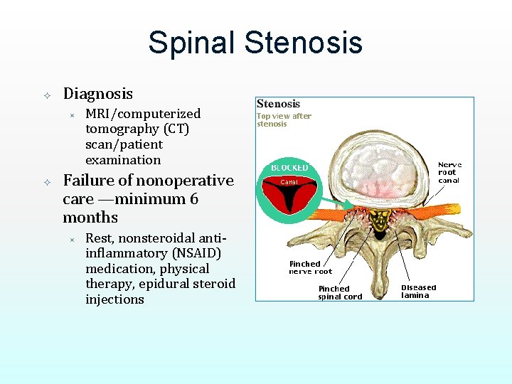 Spinal Stenosis Diagnosis ³ MRI/computerized tomography (CT) scan/patient examination Failure of nonoperative care —minimum