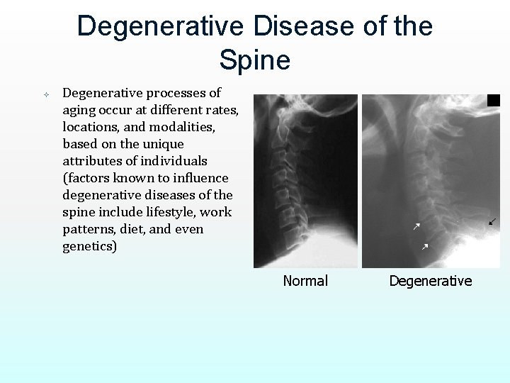 Degenerative Disease of the Spine Degenerative processes of aging occur at different rates, locations,
