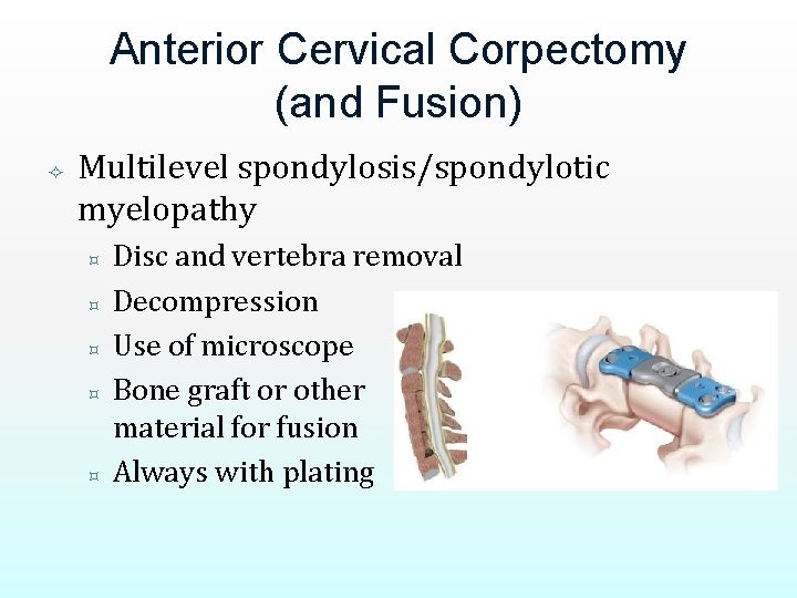Anterior Cervical Corpectomy (and Fusion) Multilevel spondylosis/spondylotic myelopathy ³ ³ ³ Disc and vertebra