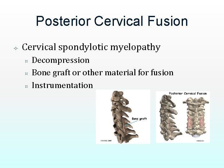 Posterior Cervical Fusion Cervical spondylotic myelopathy ³ ³ ³ Decompression Bone graft or other