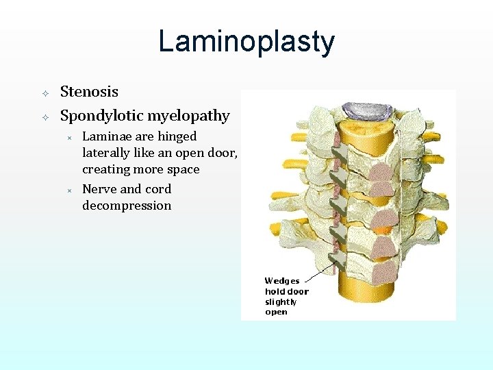 Laminoplasty Stenosis Spondylotic myelopathy ³ ³ Laminae are hinged laterally like an open door,