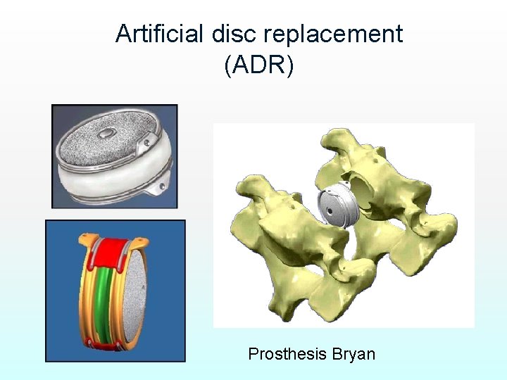 Artificial disc replacement (ADR) Prosthesis Bryan 