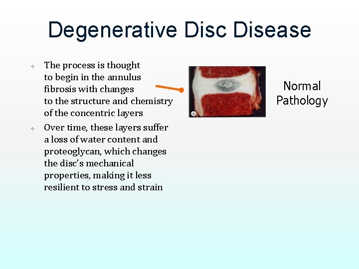 Degenerative Disc Disease The process is thought to begin in the annulus fibrosis with