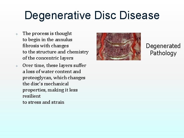 Degenerative Disc Disease The process is thought to begin in the annulus fibrosis with