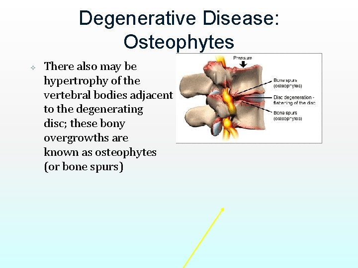 Degenerative Disease: Osteophytes There also may be hypertrophy of the vertebral bodies adjacent to