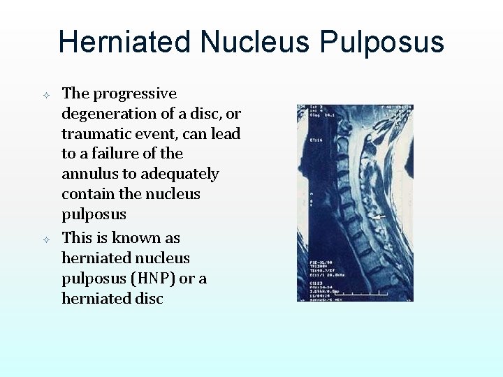 Herniated Nucleus Pulposus The progressive degeneration of a disc, or traumatic event, can lead