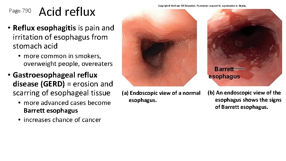Page 790 Acid reflux Copyright © Mc. Graw-Hill Education. Permission required for reproduction or