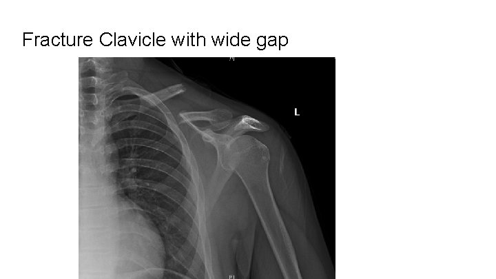 Fracture Clavicle with wide gap 