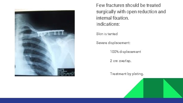 Few fractures should be treated surgically with open reduction and internal fixation. Indications: Skin