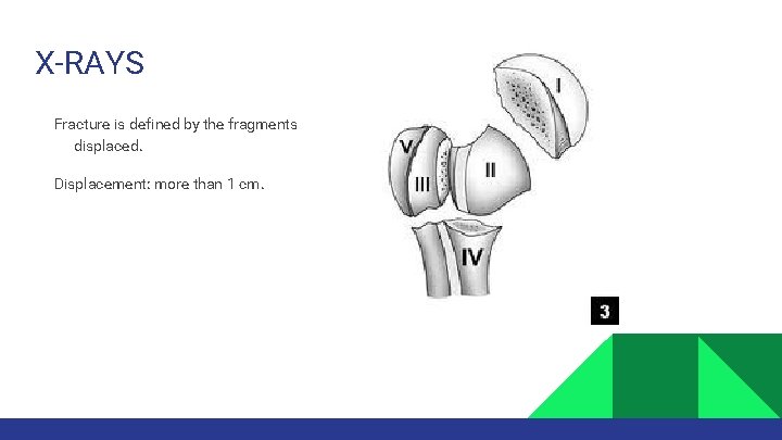 X-RAYS Fracture is defined by the fragments displaced. Displacement: more than 1 cm. 
