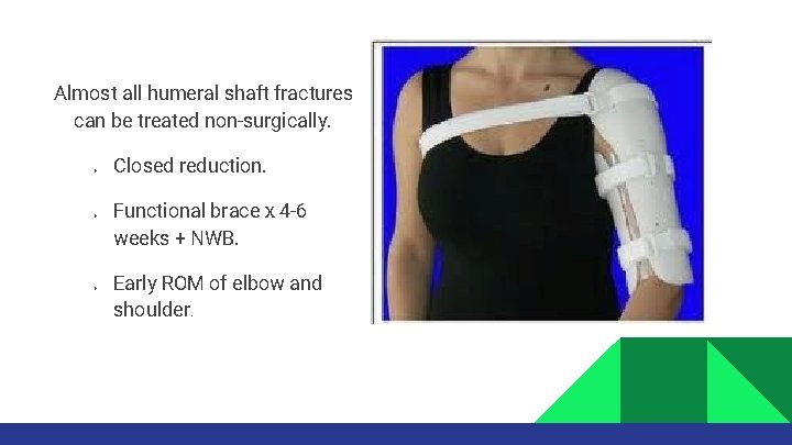 Almost all humeral shaft fractures can be treated non-surgically. Ø Ø Ø Closed reduction.