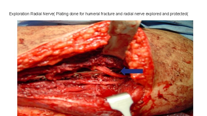Exploration Radial Nerve( Plating done for humeral fracture and radial nerve explored and protected(