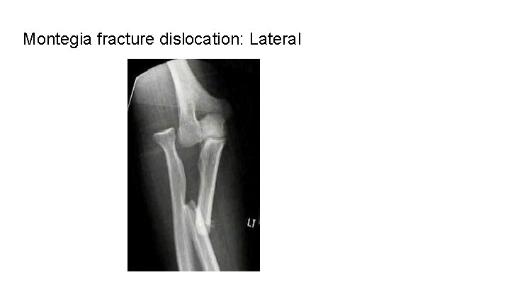 Montegia fracture dislocation: Lateral 