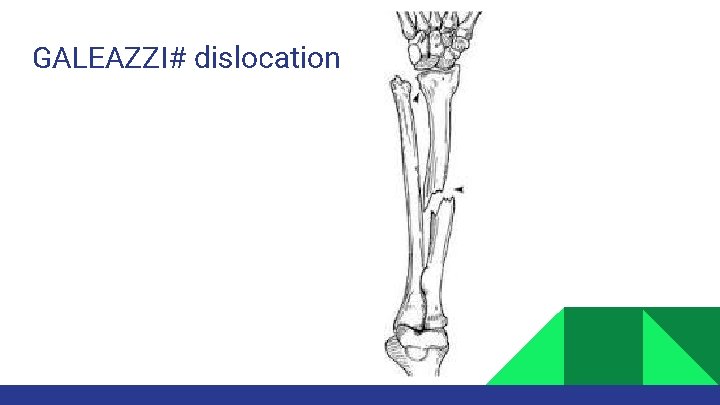 GALEAZZI# dislocation 